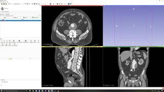 3D Slicer Tutorial 2 Manual segmentation Thresholding [upl. by Michaella]