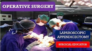 VideoAssisted Thoracoscopic Surgery [upl. by Oznol]