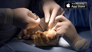 Carpal Tunnel Surgery [upl. by Leo]