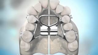 Surgically Assisted Palatal Expansion [upl. by Nicolina]