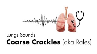 Coarse Crackles Rales  Lung Sounds  Medzcool [upl. by Hulbert]