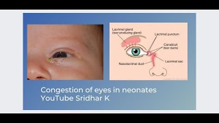 Is my babys eyes infected What is this sticky discharge Dr Sridhar K [upl. by Petula]