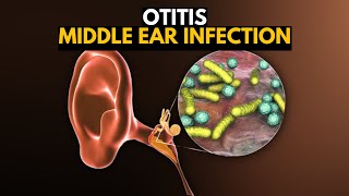 Middle Ear Infection Otitis Media Causes SIgns and Symptoms Diagnosis and Treatment [upl. by Foah]