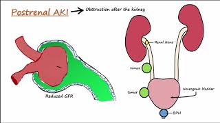 Acute Kidney Injury AKI  PrerenalIntrarenalPostrenal [upl. by Meit]