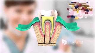 What is a Root Canal Treatment [upl. by Benjamen]