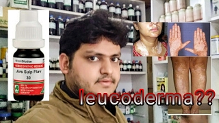 leucoderma vitiligo treatment by homeopathic medicine explain [upl. by Nallid]