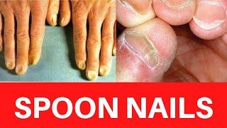 SPOON NAILS  Koilonychia Causes Treatment Symptoms Iron deficiency Anemia Cure Prevention [upl. by Bradway991]