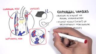 Upper GI Bleed Causes Overview [upl. by Ettenan]