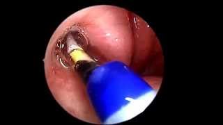 Eustachian Tube Balloon Dilation [upl. by Birk]