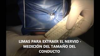 Video de Tratamiento de Conductos [upl. by Vanhook398]