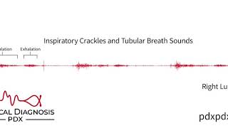 The Lung Sounds of Pneumonia [upl. by Geraldina]