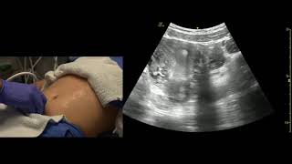 Gallbladder Scan Techniques Subcostal Midclavicular Window [upl. by Symon]