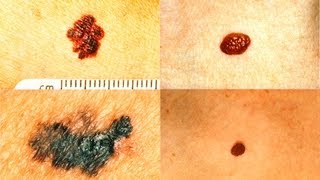 Atypical Moles or Melanoma The ABCDEs Dermatology [upl. by Sunshine]