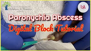 Finger Paronychia Emergency amp Digital Block Tutorial [upl. by Donela]