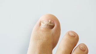 How to prevent and treat nail fungus [upl. by Maggee]