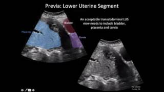 Ultrasound Diagnosis of Placenta Accreta A Tutorial for Imagers [upl. by Schuster]