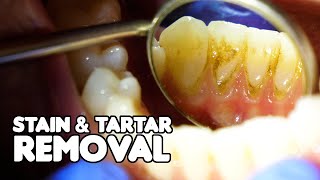 Dental Cleaning EXPLAINED  Stain amp Tartar Removal [upl. by Corwin]