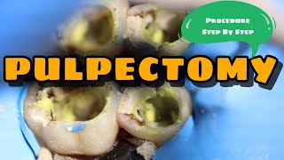 Pulpectomy  Procedure Step By Step  Kedo Square File [upl. by Sullecram]