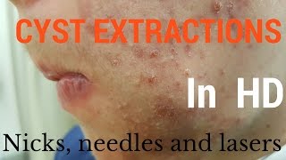 Cysts extractions blackheads  Removal methods in HD [upl. by Adalheid422]