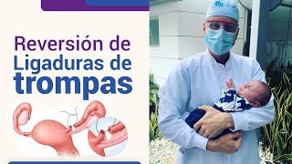 Reversión de la ligadura de trompas l Dr Juan Luis Giraldo [upl. by Travus]