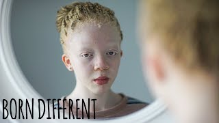 I’m Black Even With Albinism  BORN DIFFERENT [upl. by Olia]