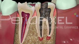 Vídeo 3D Endodoncia en Caries Profunda  PerioPixel [upl. by Christoper]