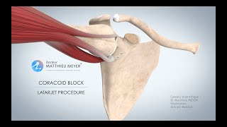 SHOULDER STABLISATION BY CORACOID BLOCK LATARJET PROCEDURE  DR MATTHIEU MEYER  PARIS FRANCE [upl. by Etty699]