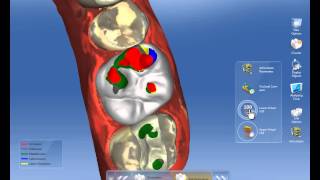 CEREC Software 42  Virtual Articulation [upl. by Serrano]