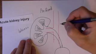 Acute Kidney Injury 1 Pre Renal Causes of AKI [upl. by Ettezzil546]