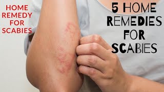 5 Home Remedies for Scabies  home remedy for scabies [upl. by Hilel95]