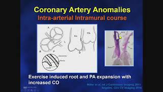 Congenital pulmonary airway malformation  an Osmosis preview [upl. by Zorina]