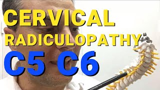 What Is C5 C6 Radiculopathy What Causes Cervical Radiculopathy Dr Walter Salubro [upl. by Marthe]