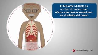 Mieloma múltiplo  Aula de hematologia SanarFlix [upl. by Niro]