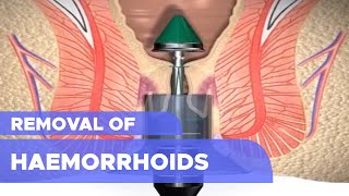 Removal of Haemorrhoids [upl. by Hendren564]