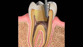 Endodoncia Tratamiento de conducto [upl. by Spearman444]