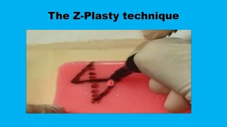 5 The Z PLASTY [upl. by Navad957]