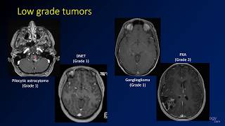 Differentiating epiphyseal lesions Chondroblastoma vs Giant cell tumor [upl. by Assili]