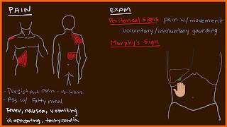 Acute Cholecystitis 23 [upl. by Vocaay940]