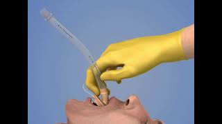 Laryngeal Mask Airway Insertion [upl. by Ecnedurp550]