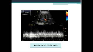 TMT Renal Doppler Part III Assessing Renal Artery Stenosis [upl. by Niehaus]