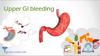 Quick review Upper GI Bleeding GI Bleed Upper GI Bleed Causes [upl. by Attehcram]