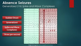 Absence Seizures EEG Findings [upl. by Valleau]