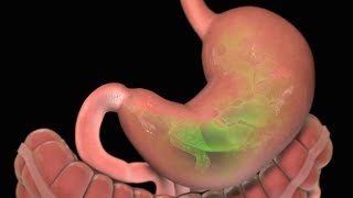 Stomach Ulcer  Nucleus Health [upl. by Aderf]