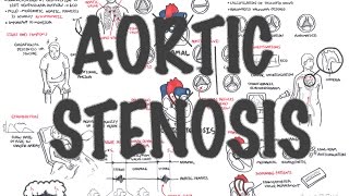 Aortic Stenosis in Seniors Explained [upl. by Akimyt]