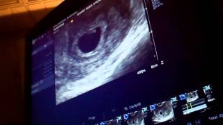 Ultrasound 6 weeks 3 days [upl. by Aihsyak]