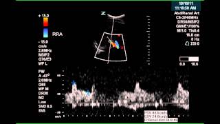 LAD InStent Restenosis [upl. by Friedberg]