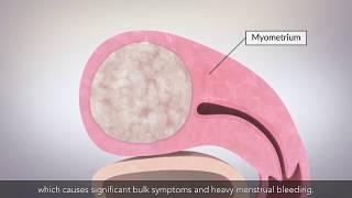 Laparoscopic myomectomy [upl. by Gronseth]