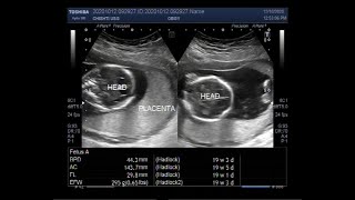 Placenta positions during pregnancy Anterior and posterior placenta se boy or girl myths [upl. by Oleusnoc]