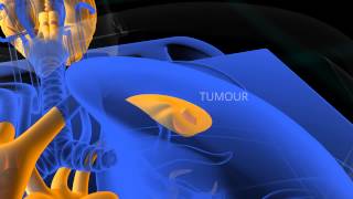 PET Scan animation [upl. by Onin950]