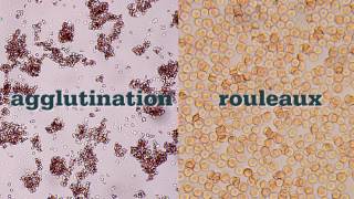 SHORT SYNACTHEN TEST ACTH stimulation test made simple [upl. by Bachman]